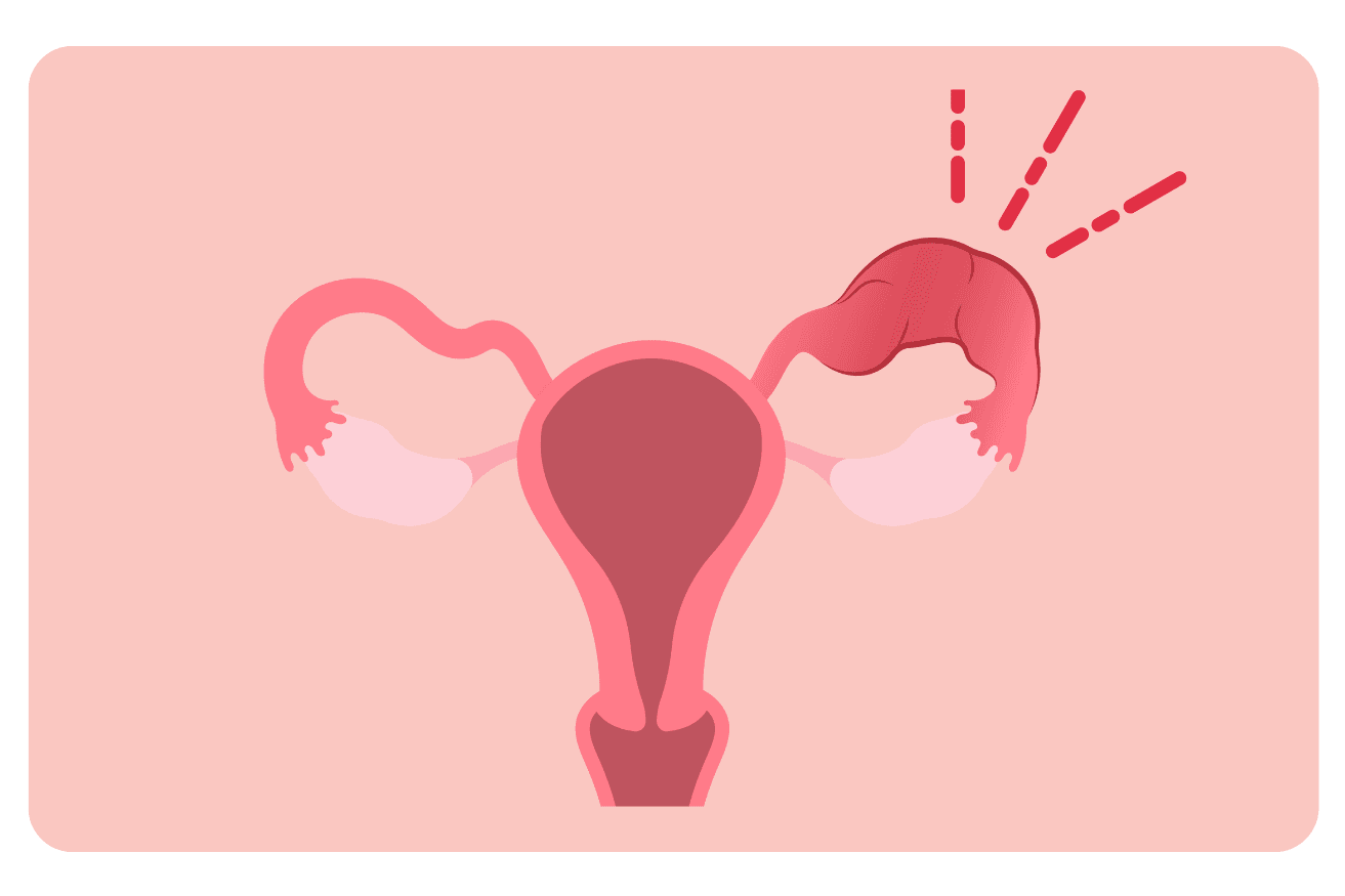 Infection pelvienne (PID) : Symptômes, Causes et Traitements efficaces